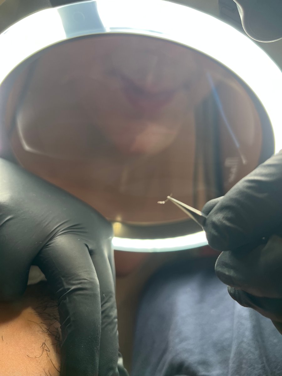 Séance d'électrolyse à l'aiguille sous loupe lumineuse